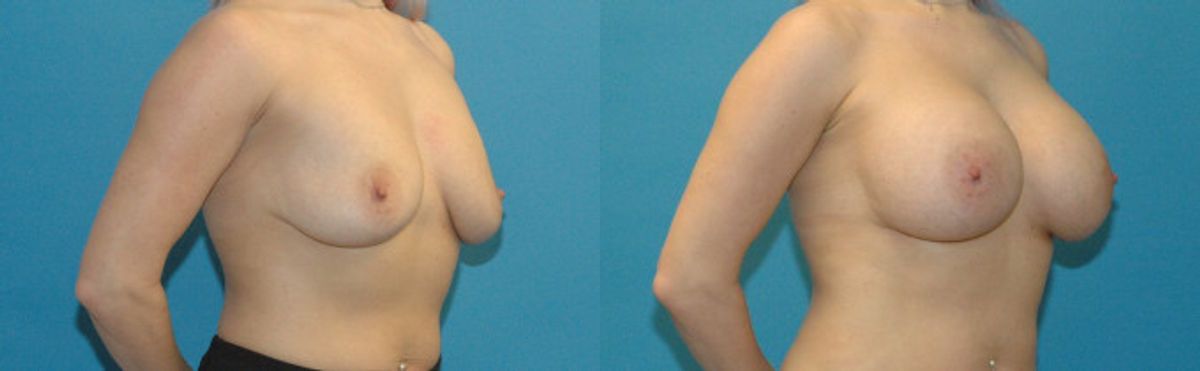 Breast Implant #91 - Before and After