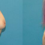 Breast Implant #91 - Before and After