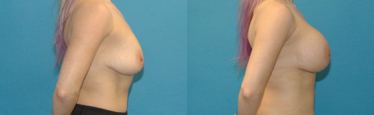 Breast Implant #91 - Before and After