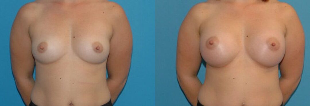 Breast Implant #92