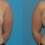 Breast Implant #92 - Before and After