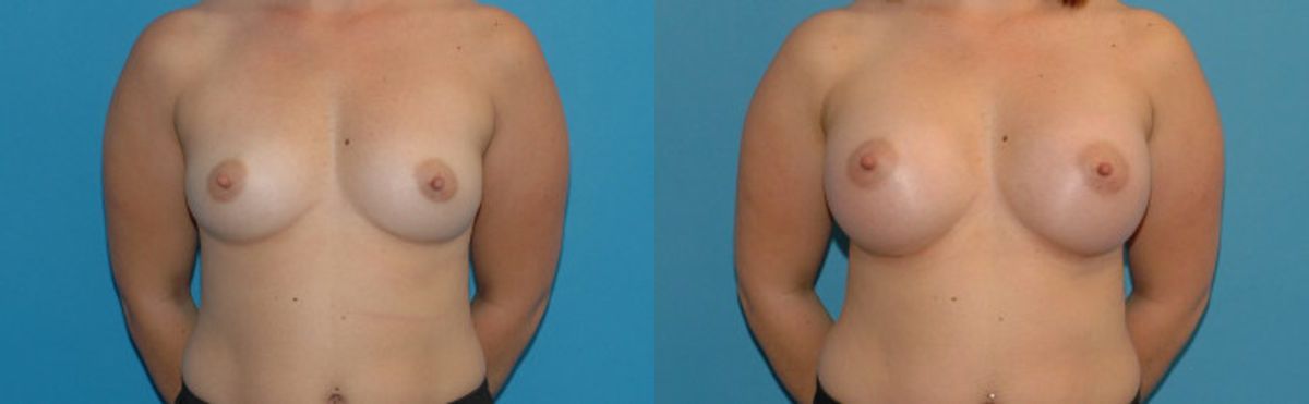 Breast Implant #92 - Before and After
