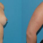 Breast Implant #92 - Before and After