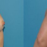 Breast Implant #92 - Before and After