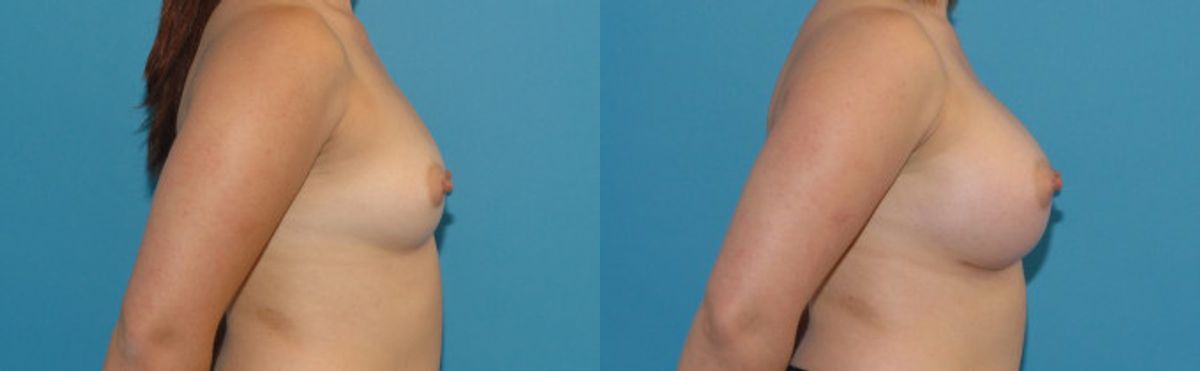 Breast Implant #92 - Before and After