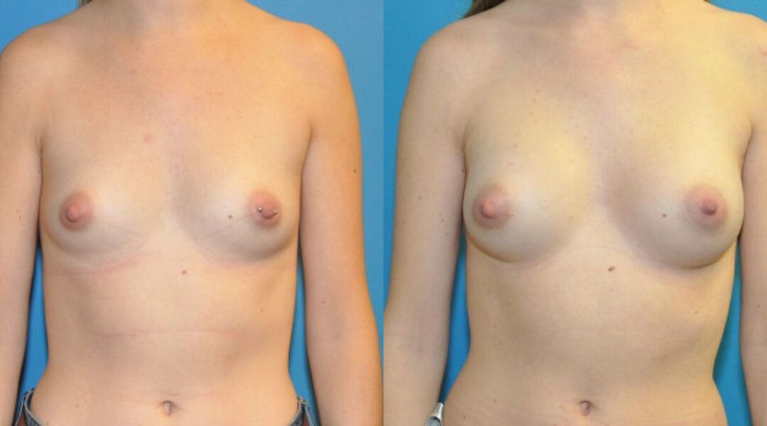 Breast Implant #93