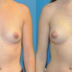 Breast Implant #93 - Before and After
