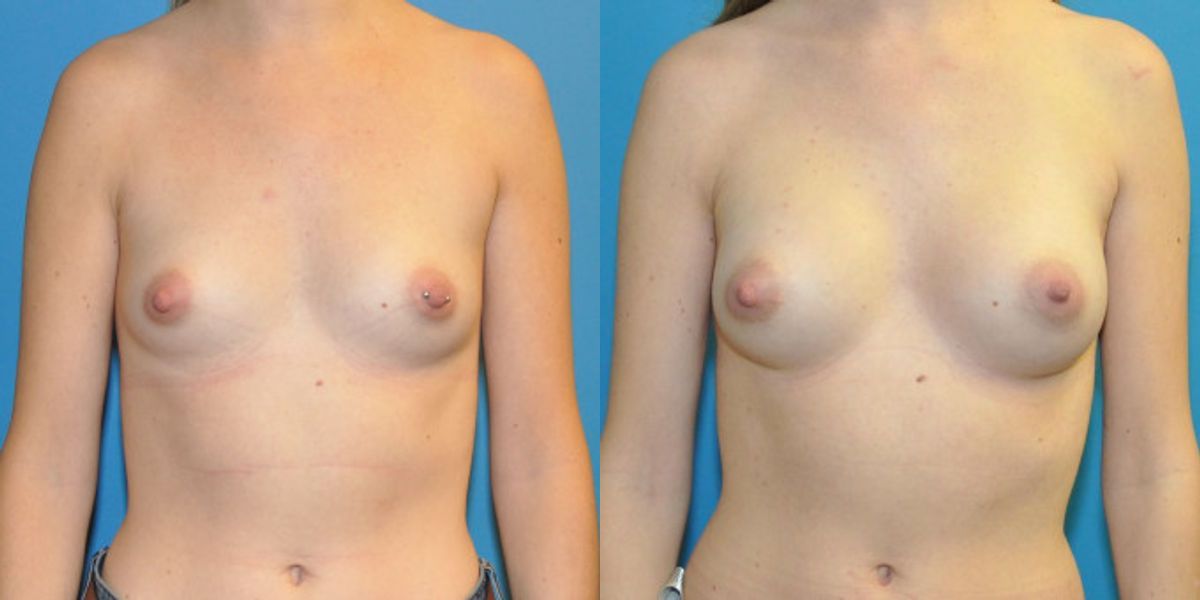 Breast Implant #93 - Before and After