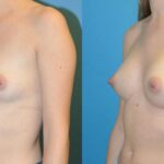Breast Implant #93 - Before and After