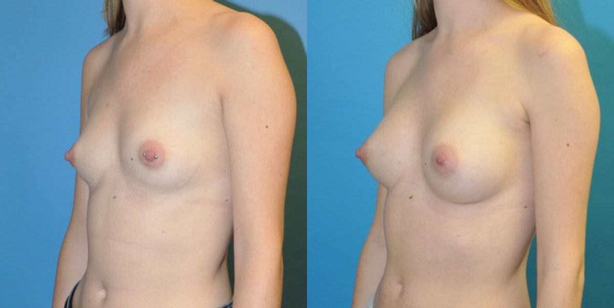 Breast Implant #93 - Before and After