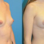 Breast Implant #93 - Before and After