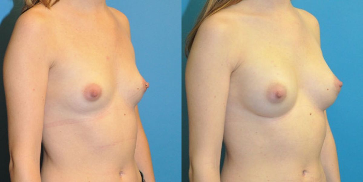 Breast Implant #93 - Before and After