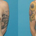 Breast Implant #94 - Before and After