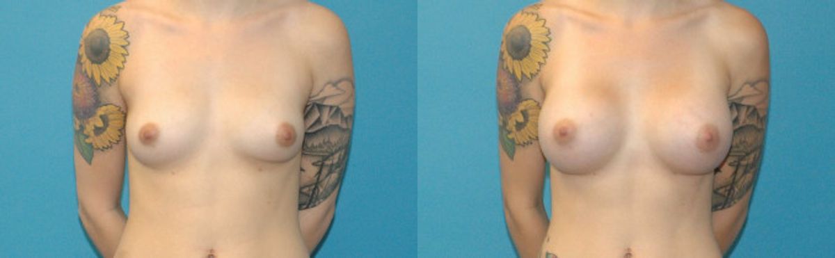 Breast Implant #94 - Before and After