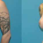 Breast Implant #94 - Before and After