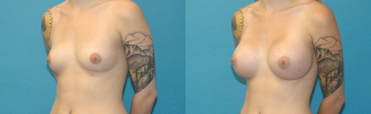 Breast Implant #94 - Before and After