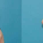 Breast Implant #94 - Before and After