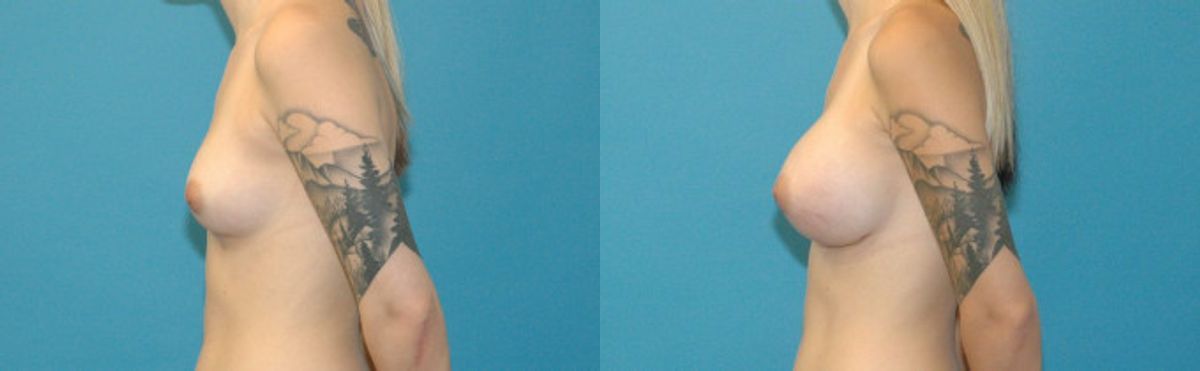 Breast Implant #94 - Before and After