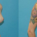 Breast Implant #94 - Before and After