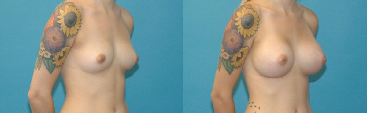 Breast Implant #94 - Before and After