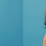 Breast Implant #94 - Before and After