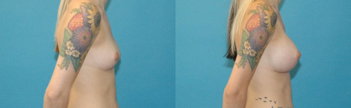 Breast Implant #94 - Before and After