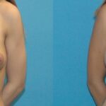 Breast Implant #95 - Before and After