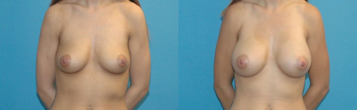Breast Implant #95 - Before and After