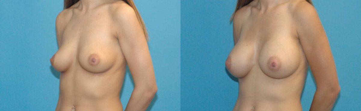 Breast Implant #95 - Before and After