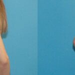 Breast Implant #95 - Before and After