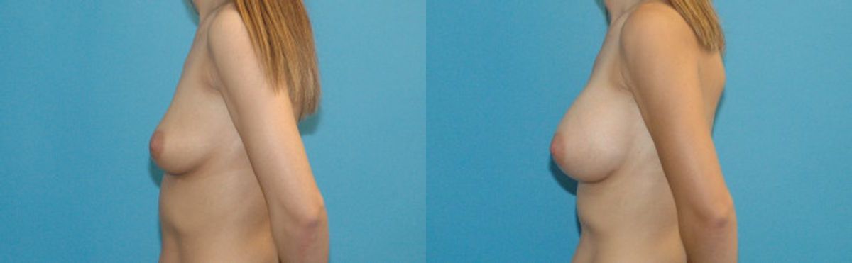 Breast Implant #95 - Before and After