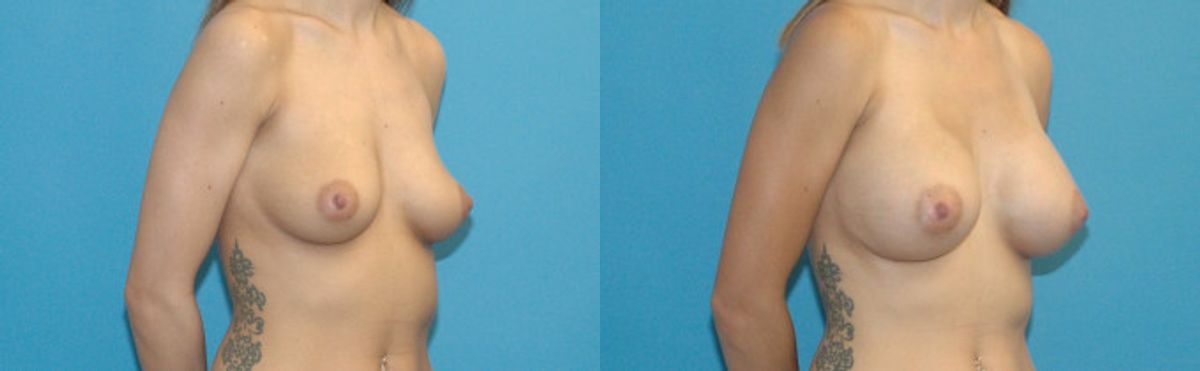 Breast Implant #95 - Before and After