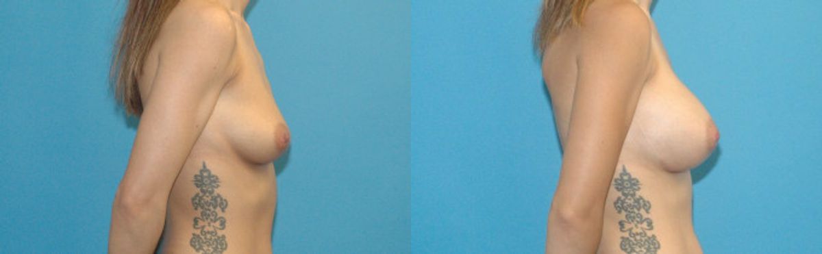 Breast Implant #95 - Before and After