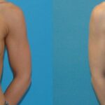 Breast Implant #96 - Before and After