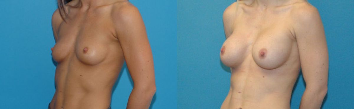 Breast Implant #96 - Before and After