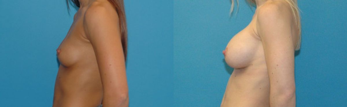 Breast Implant #96 - Before and After