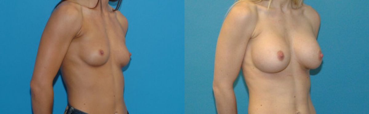 Breast Implant #96 - Before and After