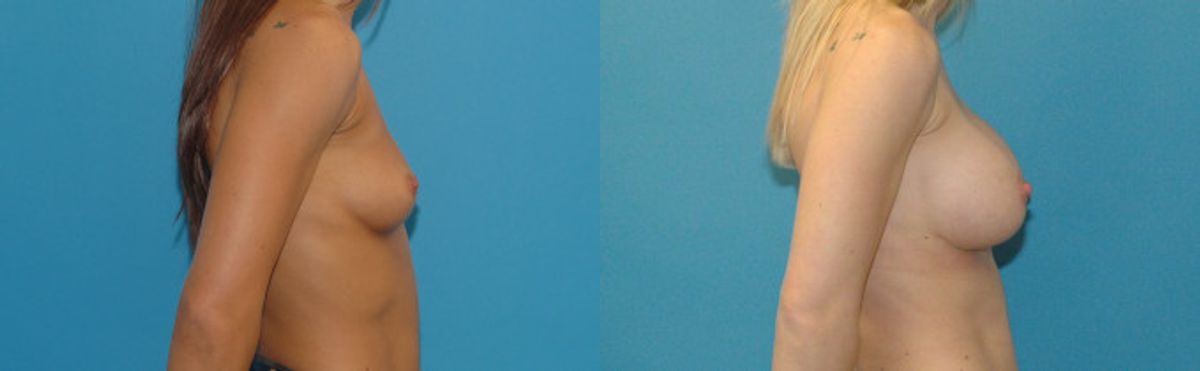 Breast Implant #96 - Before and After