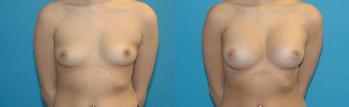 Breast Implant #97 - Before and After