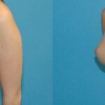 Breast Implant #97 - Before and After