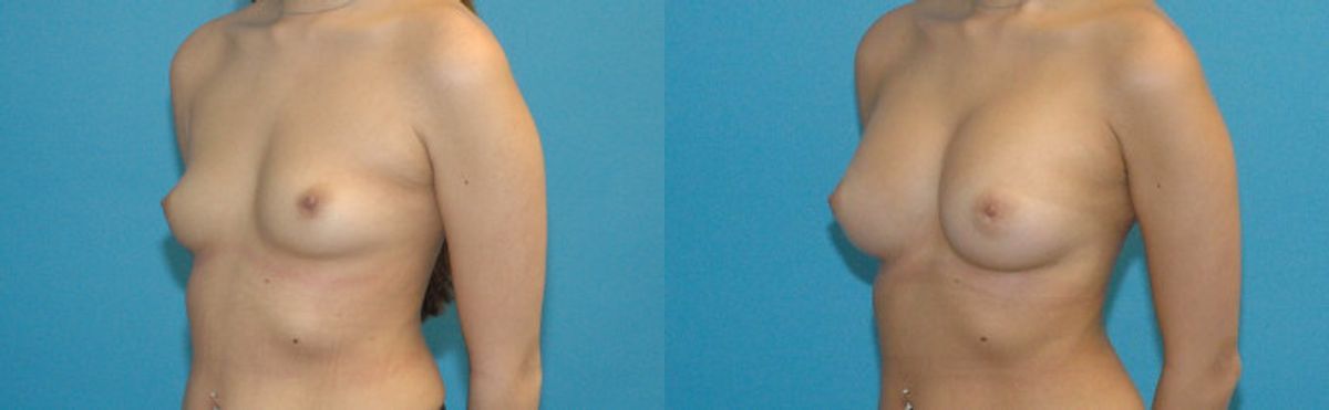 Breast Implant #97 - Before and After