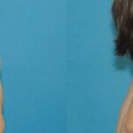 Breast Implant #97 - Before and After