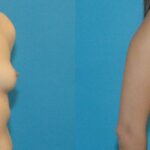 Breast Implant #97 - Before and After