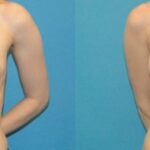 Breast Implant #98 - Before and After