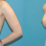 Breast Implant #98 - Before and After