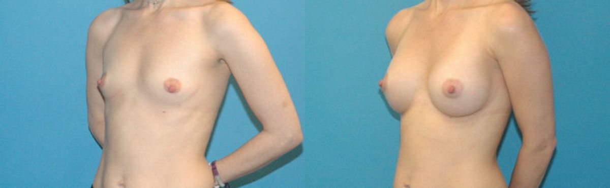 Breast Implant #98 - Before and After