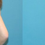 Breast Implant #98 - Before and After