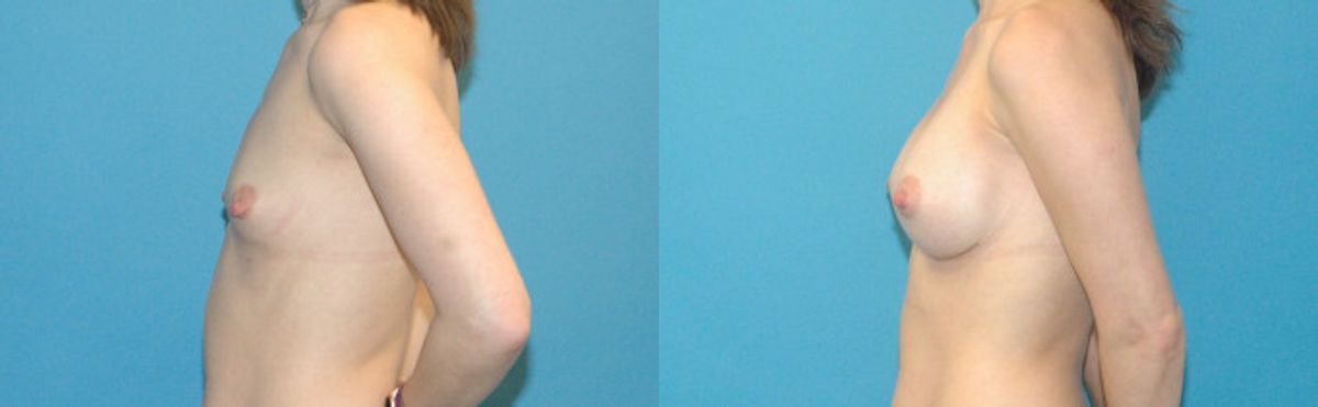 Breast Implant #98 - Before and After