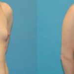 Breast Implant #98 - Before and After