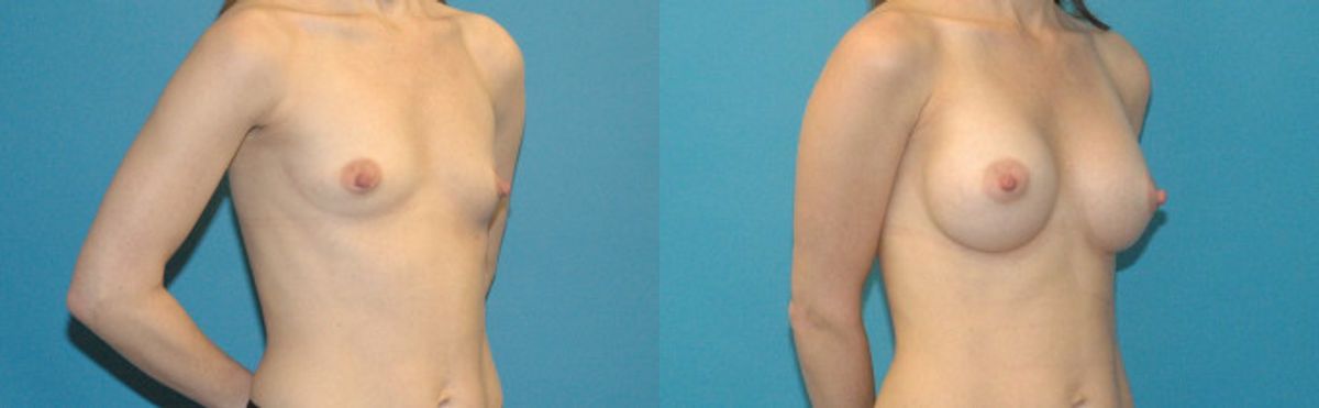 Breast Implant #98 - Before and After